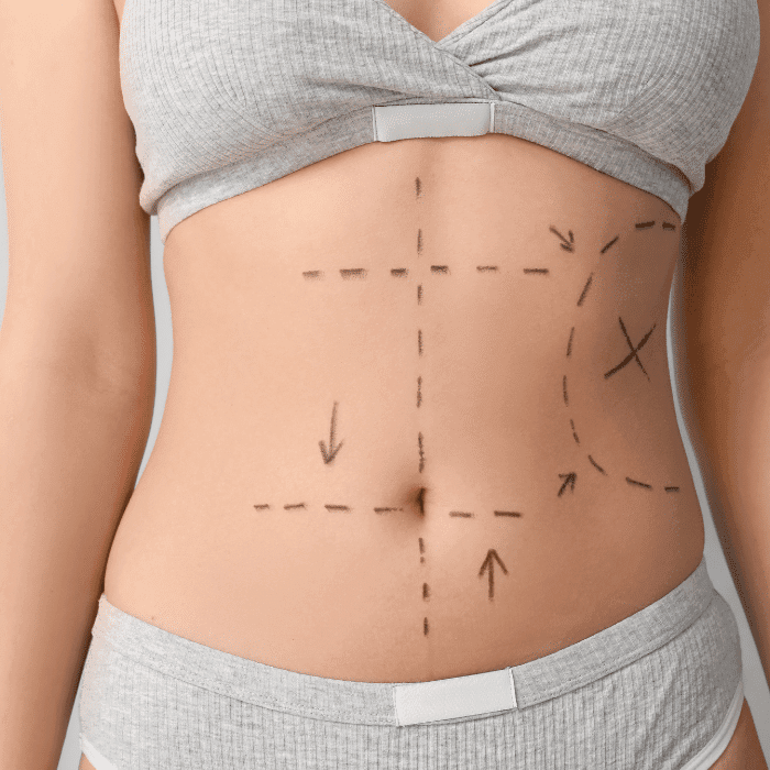 Abdominoplastia | medconnectlatam.com