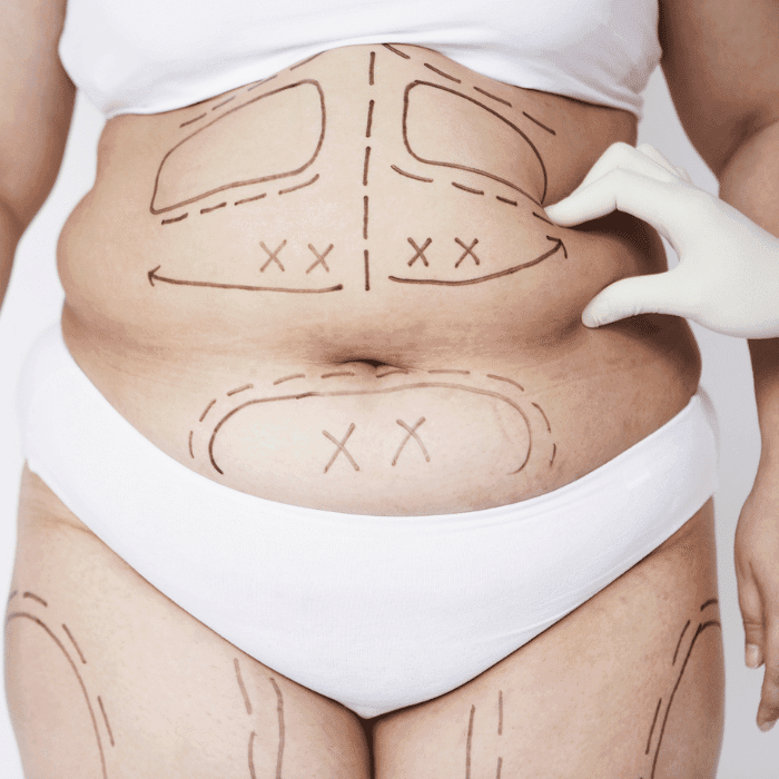 Liposuccion | medconnectlatam.com