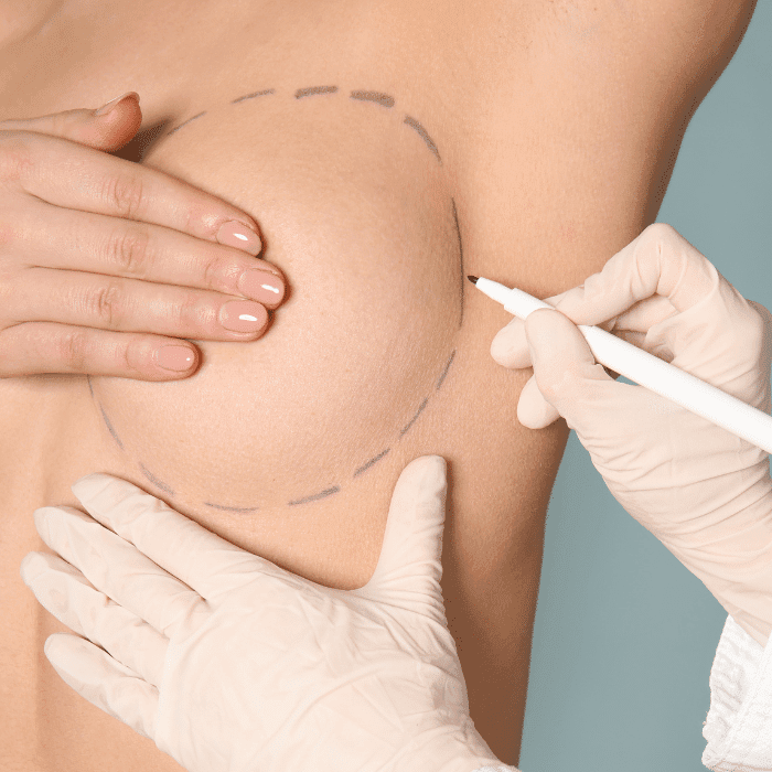 Mamoplastia de Aumento | medconnectlatam.com